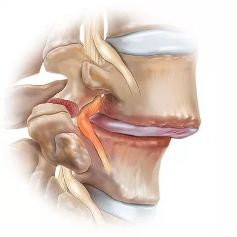 Best Exercises For Cervical Spondylosis