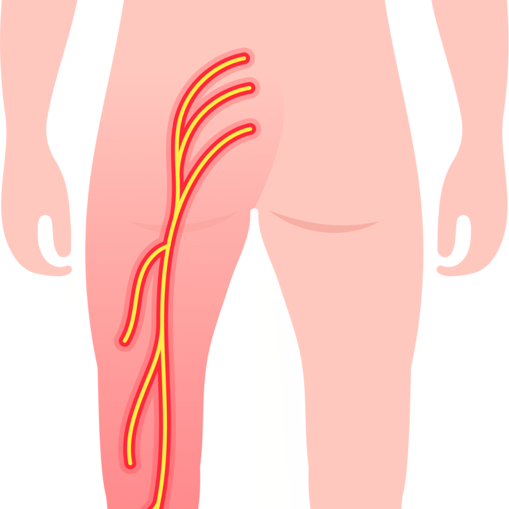 Sciatica Treatment in jaipur