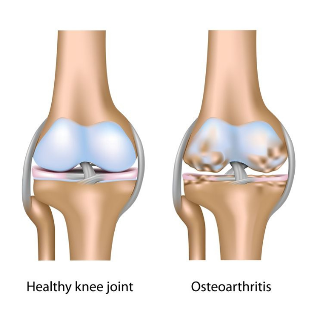 Osteoarthritis treatment in jagatpura