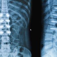 Slip Disc Treatment in Jagatpura, jaipur