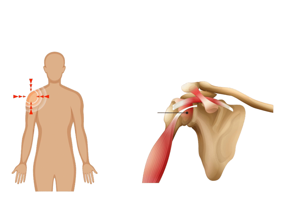 Shoulder pain treatment in jagatpura jaipur