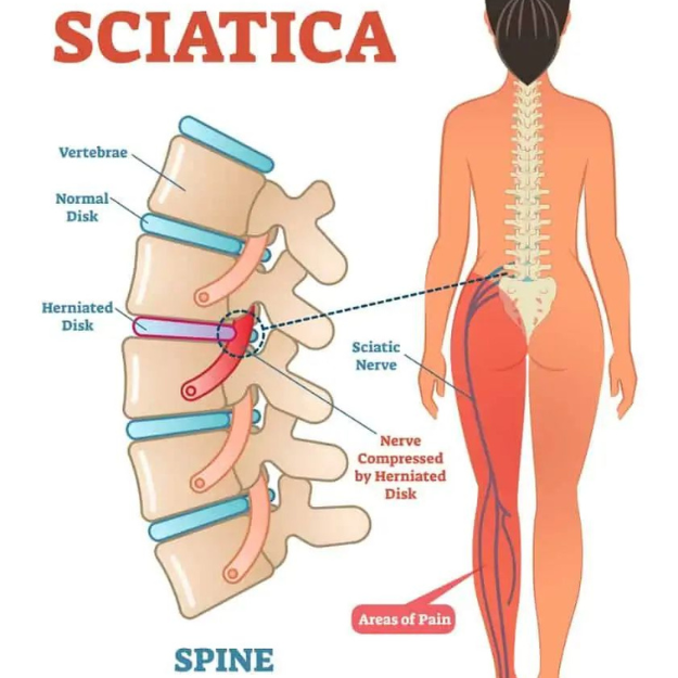Slip disc Physiotherapy in jagatpura